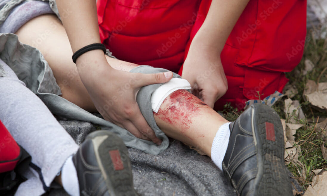 Can You Sue if You Get Burned at Work?